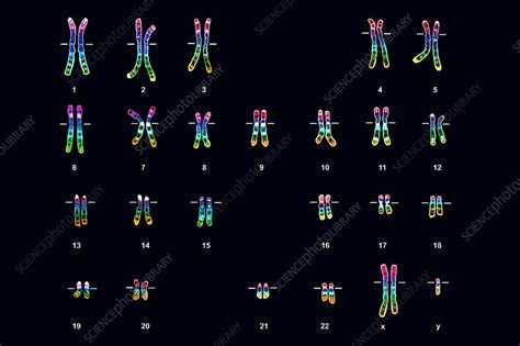 Klinefelters Syndrome Karyotype Male Stock Image C0037183 Science Photo Library