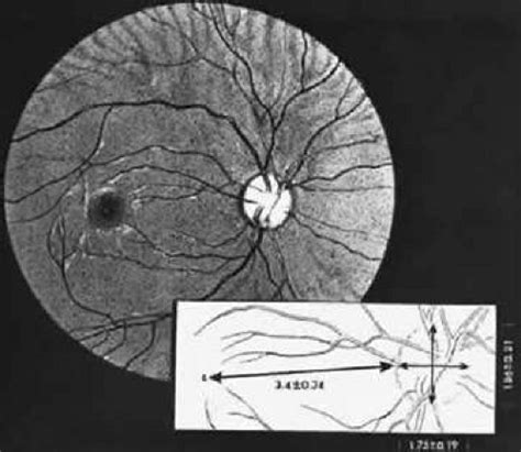 Degenerative Diseases Of The Peripheral Retina Ento Key