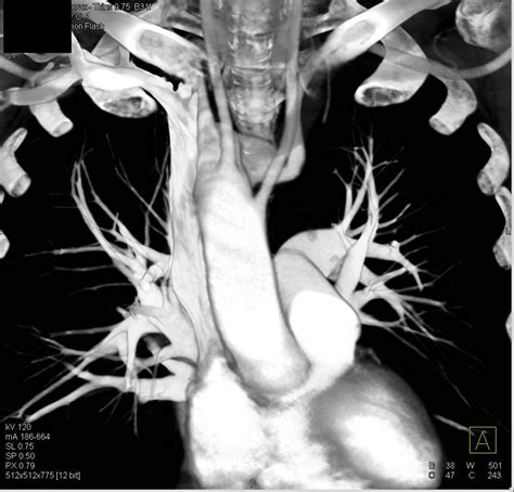 Right Aortic Arch With Aberrant Left Subclavian Artery Vascular Case