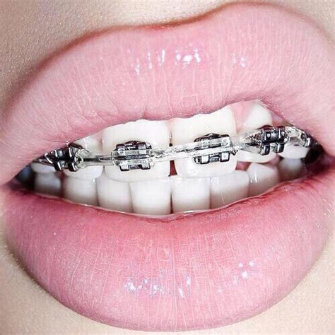 Selfies Exclusivas Para Chicas Con Brackets Es La Moda