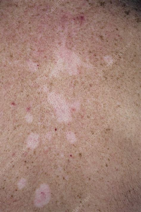 Pityriasis Versicolor Skin Infection Stock Image C0029574