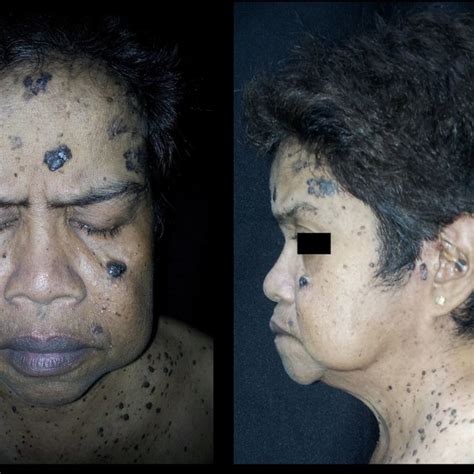 Reported Cases Of Basal Cell Nevus Syndrome 789 Download Scientific