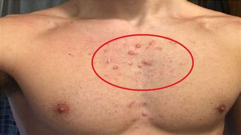 How To Get Rid Of Chest Acne Scars Overnight Youtube