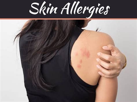 What Are The Different Kinds Of Skin Allergies Skin Allergies Scaly