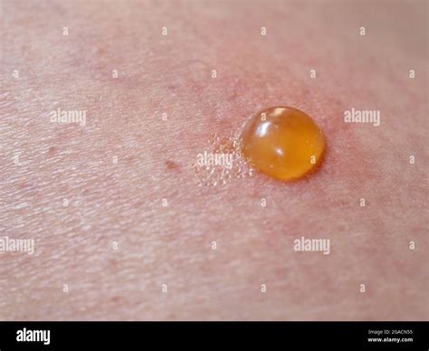 Insect Bite On Skin With Blister Stock Photo Alamy