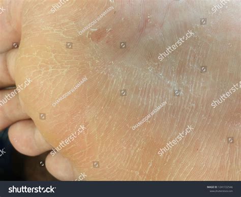Foot Ulcer Scaly Skin Disease Foto De Stock 1241722546 Shutterstock