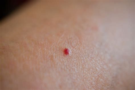 Cherry Angiomas Edmonton Dermatology