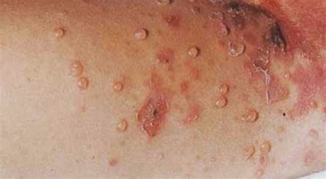 Paediatric Infectious Disease Common Skin Infection Among Children In