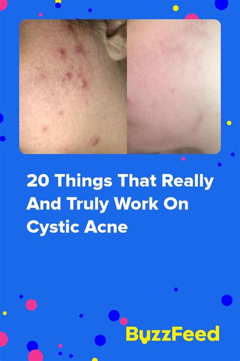 20 Things That Will Actually Treat Cystic Acne Cystic Acne Skin Acne