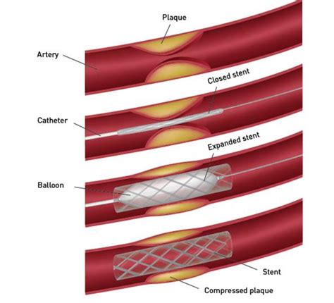 Outcomes After Angioplasty Stenting For Narrowed Coronary Arteries