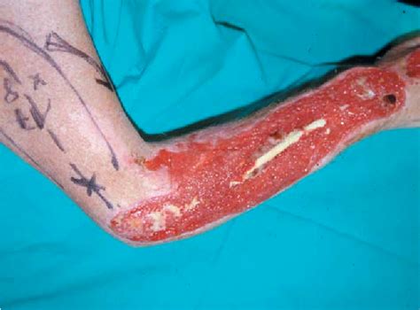 Figure 1 from The use of a free and pedicled lateral arm flap for ...