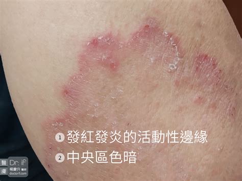 濕悶夏天的煩惱：黴菌感染（香港腳、股癬） 醫膚 楊慶升醫師 Drif 幫您解決肌膚的問題
