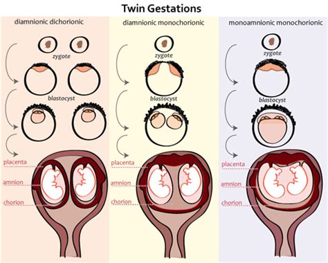 Monozygotic Vs Dizygotic Twins Embryology Medbullets Step 1