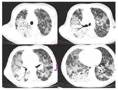 Chest Ct Scan Bilateral Multifocal Frosted Glass Pattern Pneumonic