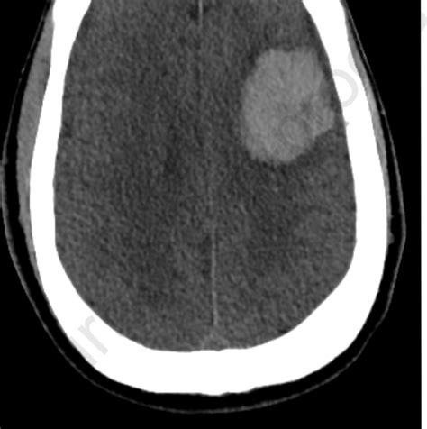 Axial Head Ct Shows A 4 Cm Left Frontal Lobe Intraparenchymal