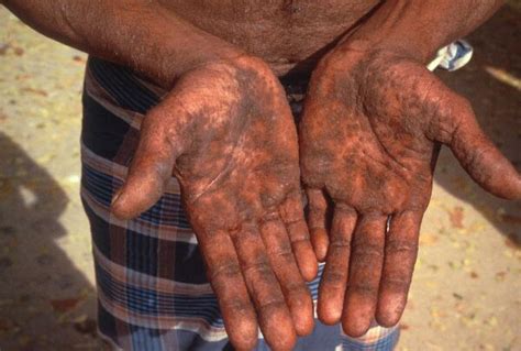 Hands Of An Arsenicosis Patient In Southern Bangladesh The New