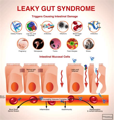 Leaky Gut Cure Review Works Or Just A Scam