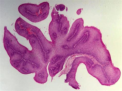 Squamous Papilloma Esophagus Hpv Squamous Papilloma Esophagus Histology