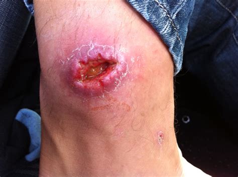It is a neglected emerging disease that has recently been reported in some. Buruli Ulcer in Australia - Curing Infections with ...