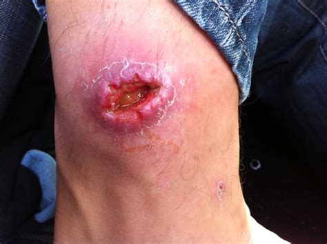 This nodule can turn into an ulcer. Buruli Ulcer in Australia - Curing Infections with ...