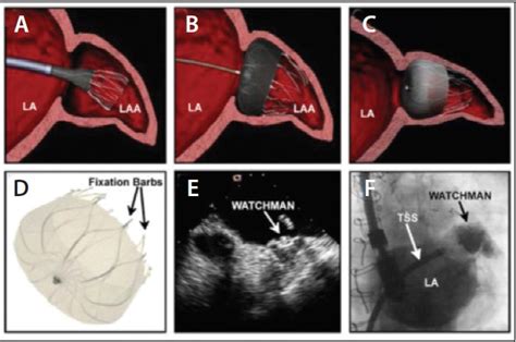 Cardiac Interventions Today Left Atrial Appendage Closure With The