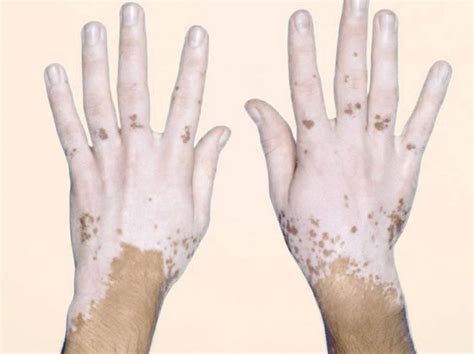 ¿qué Es El Vitiligo Causas Tratamiento Y Recomendaciones
