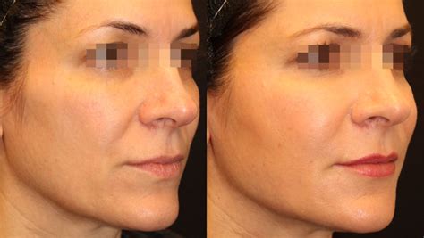 Beautifill Nasolabial Folds Inland Empire Before And After Dr Hsu