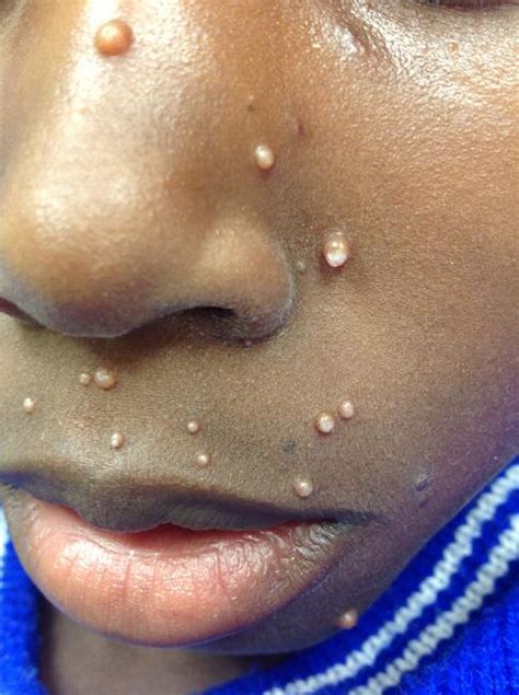 Following the incubation period, one or more lesions may appear. Skin Infections in Athletes - OrthoInfo - AAOS