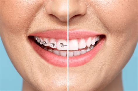 3 Surprising Facts About Adult Braces You Should Know Clear Smiles Orthodontics