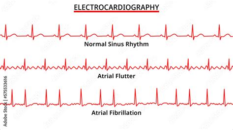 set of ecg common abnormalities atrial flutter vs atrial fibrillation normal sinus rhythm