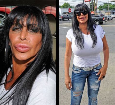 31 Plastic Surgery Gone Wrong Pictures That Will Make You Feel