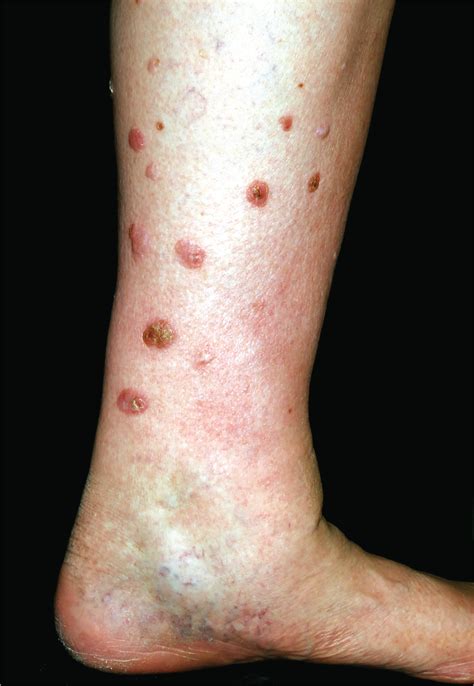 Multiple Slowly Growing Nodular Lesions On The Lower Legs In A 78 Year