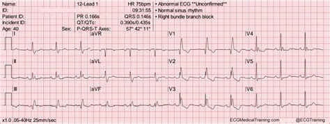 How To Calculate Heart Rate From Ecg Yoshina