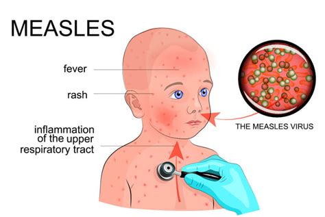 Measles Outbreaks Reported In Israel New Zealand Moldova