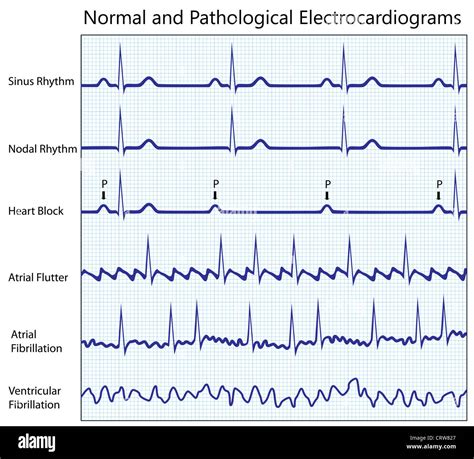 Eletrocardiograma Normal E Alterado