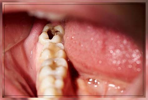 Dental Caries Treatments Signs And Symptoms Repc