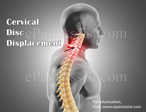 Cervical Disc Displacementcausessymptomstreatment