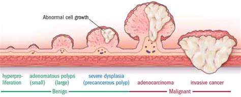 They Found Colon Polyps Now What Harvard Health