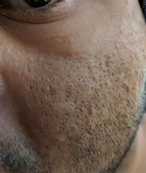 [skin concerns] how do i get rid of these holes in my face i ve had them all my life but they