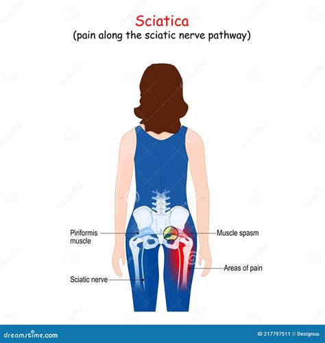 Piriformis Syndrome Rehabilitation Exercises Infographic Illustration Cartoon Vector
