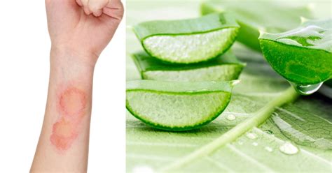 Home Remedies For Burn Relief Five Natural Foods To Use