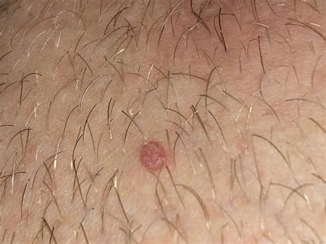 Since genital warts require treatment and are contagious, a gynecologist should make the distinction for you. Genital Wart or normal infection of the hair follicule ...