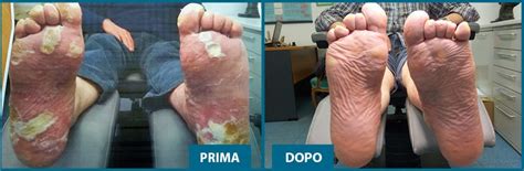 Risultati di un trattamento podologico cutaneo e plantare