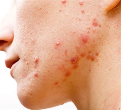 Mayway Article Differential Diagnosis Of Acne In Chinese Medicine