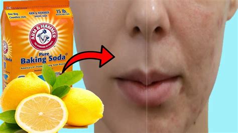 How To Get Rid Of Acne Scars And Dark Spots With Baking Soda And Lemon