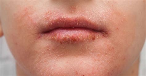Dry Scaly Rash On Upper Lip