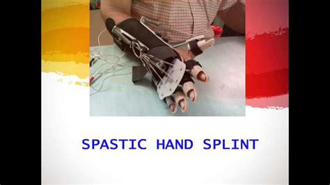 Spastic Hand Splint To Reduce Spasticity Improve Hand Function At Hope Neuro Care Hospital