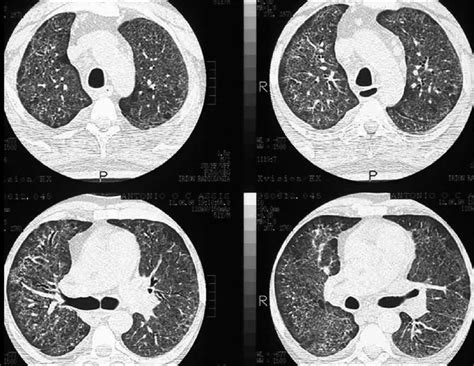 Pneumocystis Carinii Pneumonia High Resolution Computed Tomography
