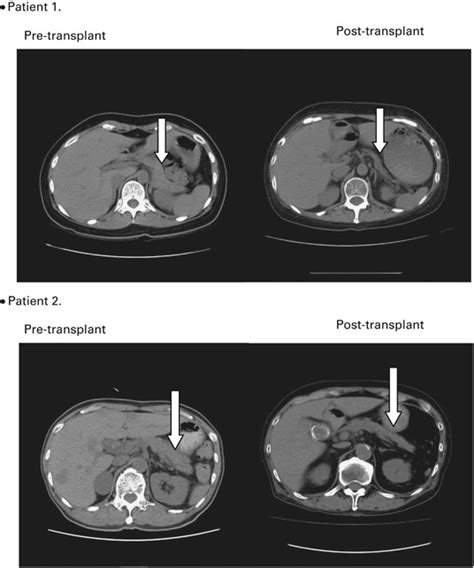 Pancreatic Atrophy Is Associated With Gastrointestinal Chronic Gvhd