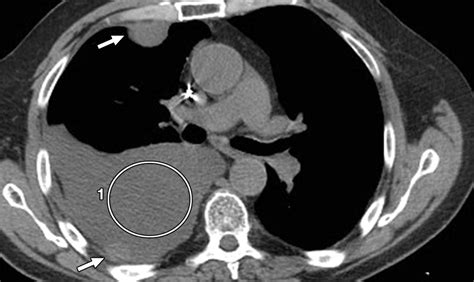 Pleural Effusion Characterization With Ct Attenuation Values And Ct Appearance Ajr